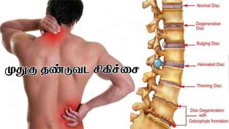 பெரம்பலூரில் தண்டுவடம் பாதிக்கப்பட்டவர்களுக்கு, மறுவாழ்வு மையம் அமைக்க கோரிக்கை!