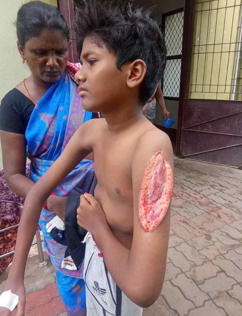 பெரம்பலூர்: தடுப்பூசி போட்டுக் கொண்ட மாணவனுக்கு அறுவை சிகிச்சை செய்யும் நிலை; அரசு உதவ கோரிக்கை!